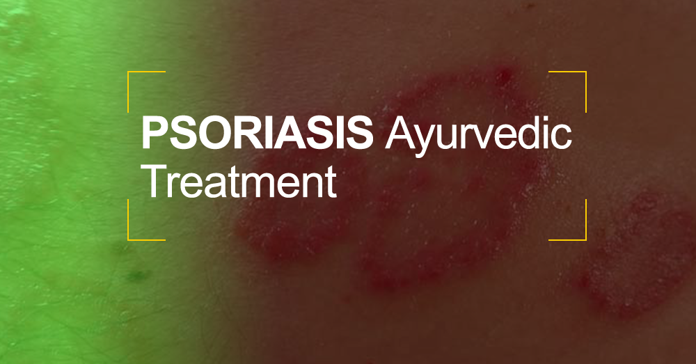 Psoriasis Ayurvedic Treatment in Kerala India @Matt India