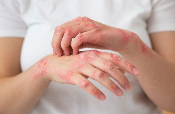 Understanding Fungal Infections and Skin Allergies from an Ayurvedic Perspective